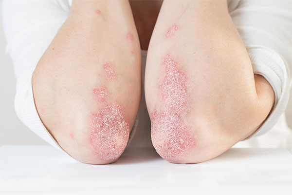 Schuppenflechte (Psoriasis) · MADERMA Hautärzte Wesel Dr. Mader und Kollegen